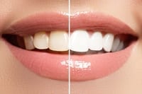 Before and after picture of teeth whitening